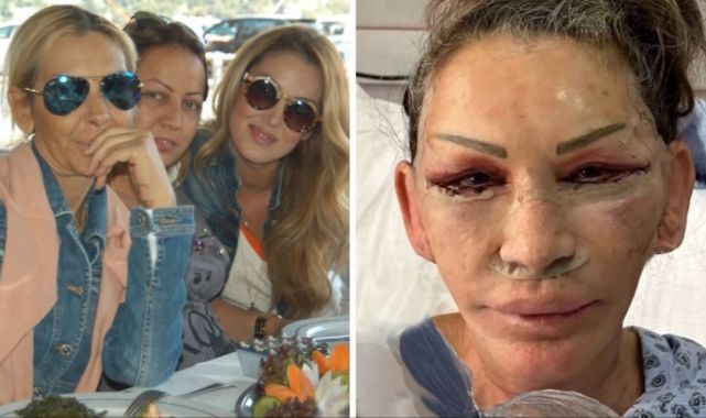 Petek Dinçöz'ün annesi yüz gerdirme ameliyatı oldu! Yeni hali kızını solladı