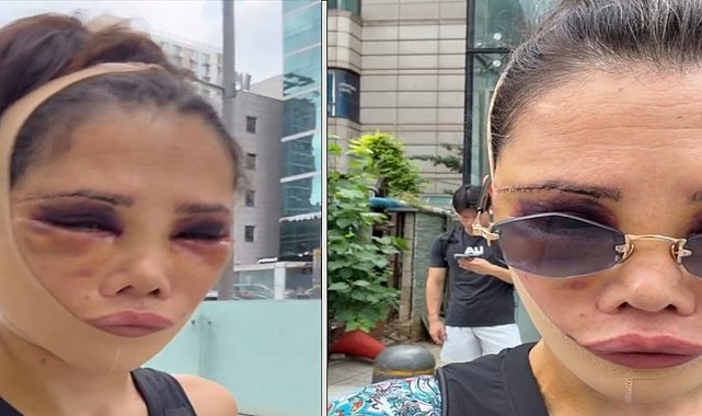 Didem Ceran yeniden ameliyat oldu: Son halini paylaşıp eleştirilere yanıt verdi