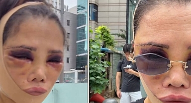 Didem Ceran yeniden ameliyat oldu: Son halini paylaşıp eleştirilere yanıt verdi